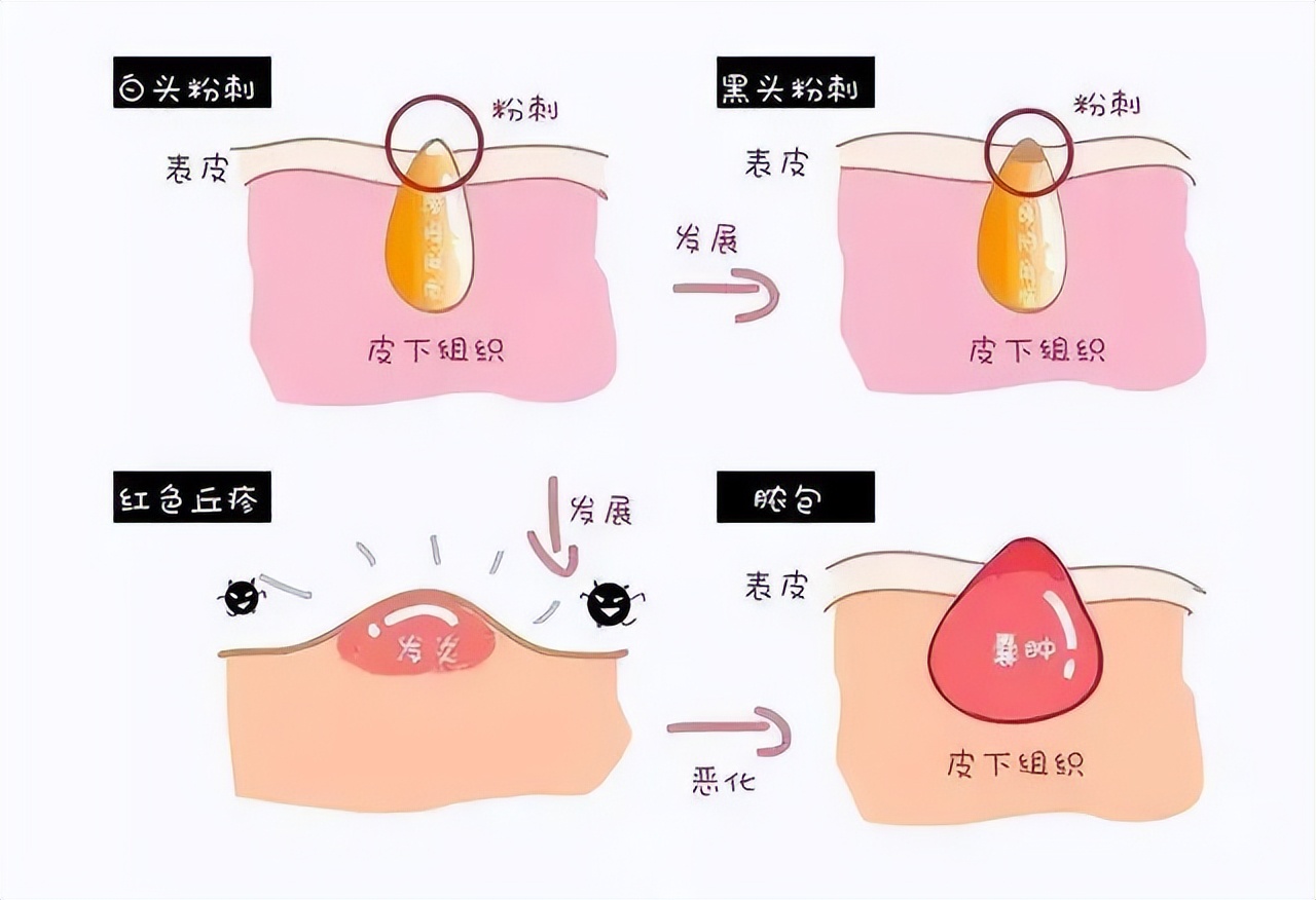 孕妇长痘痘能用什么祛痘产品,孕妇长痘可以用什么祛痘产品