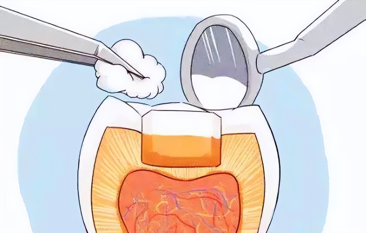 牙齿掉了一块怎么办？需要拔牙吗？