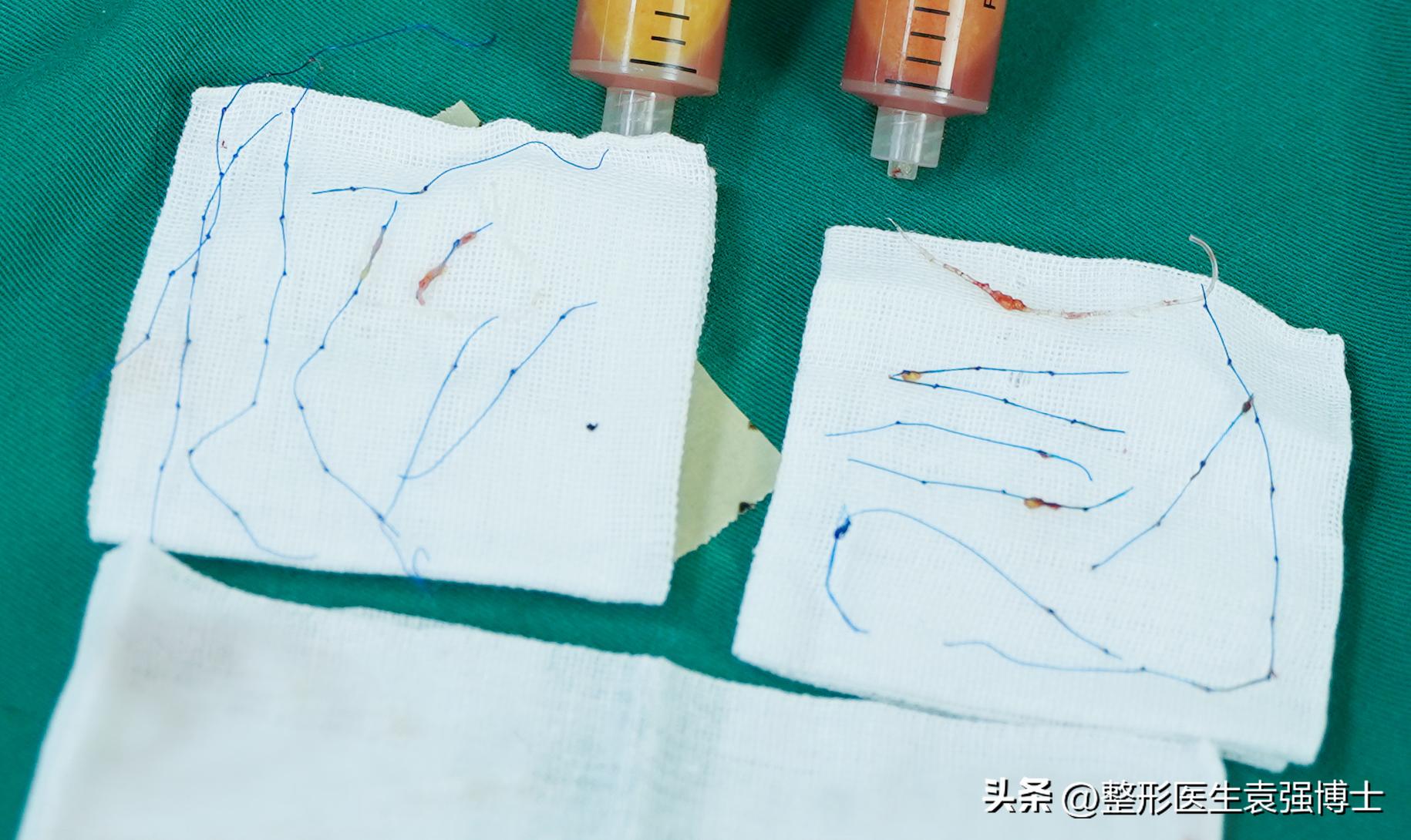 拉皮很贵吧,拉皮贵吗