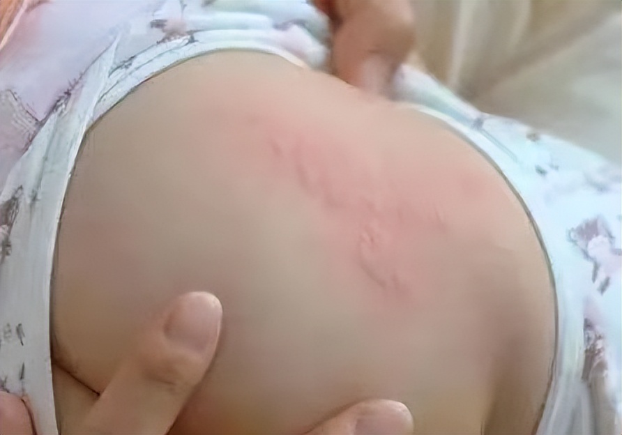 宝宝过敏起荨麻疹要不要挂急诊,宝宝得了荨麻疹需要忌口吗