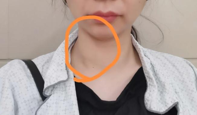 甲状腺有问题会导致贫血吗,甲状腺有问题会不会引起咳嗽