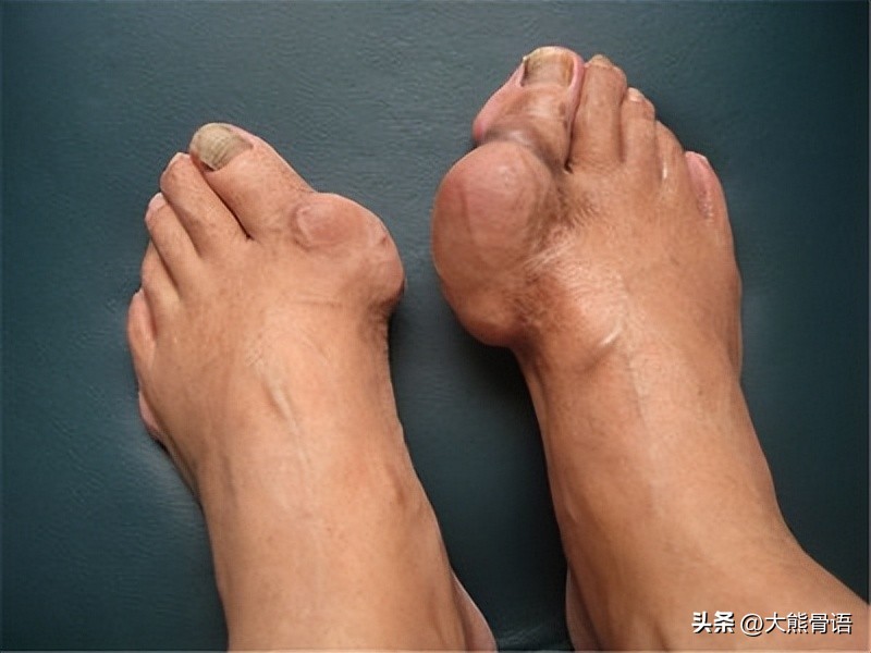 脚趾痛风的症状及治疗方法,痛风膝关节炎症状及治疗