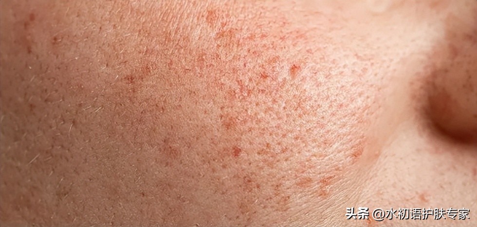 皮肤油毛孔粗大暗黄用什么护肤品,油皮毛孔粗大公认最好用的护肤水