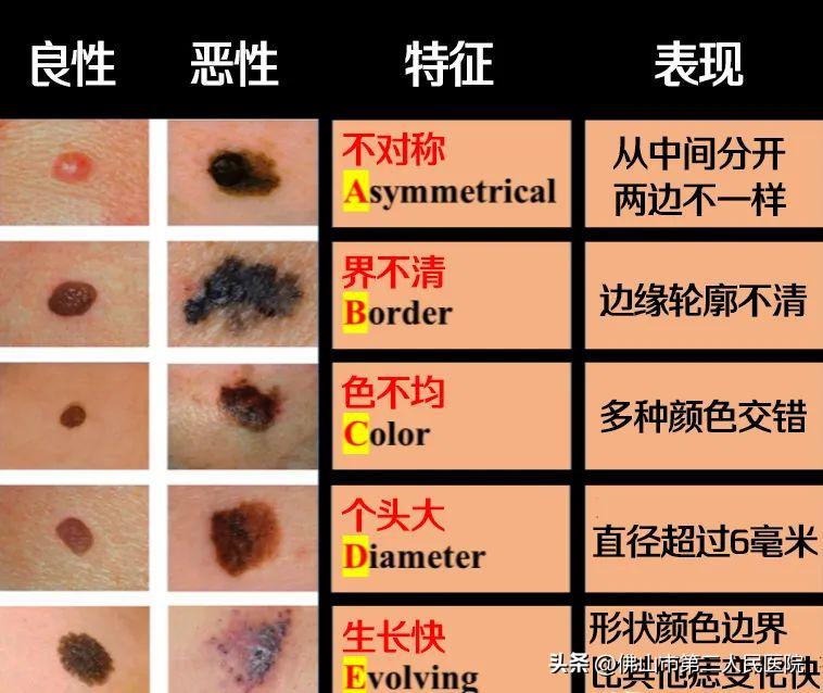 年轻歌手得黑色素瘤去世,歌手黑痣和黑色素瘤的区别