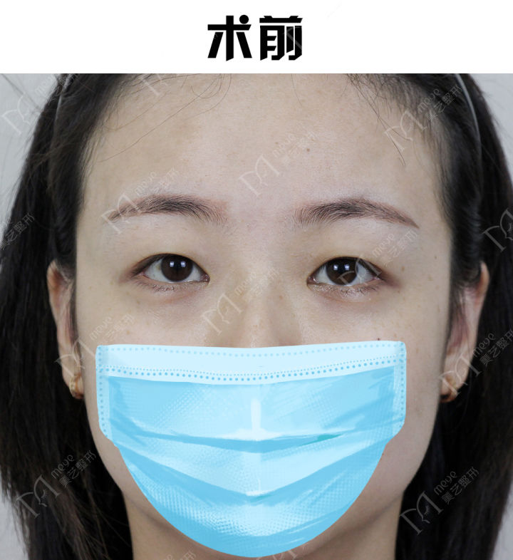 双眼皮内双和外双哪个好看,双眼皮贴内双变外双