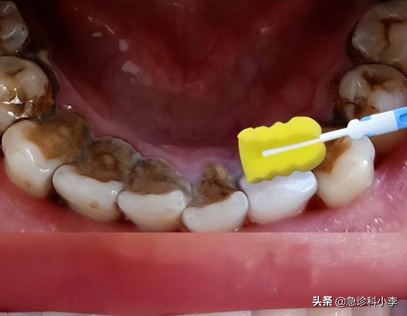 牙缝间的牙结石怎么清除,牙缝里的牙结石怎么去除