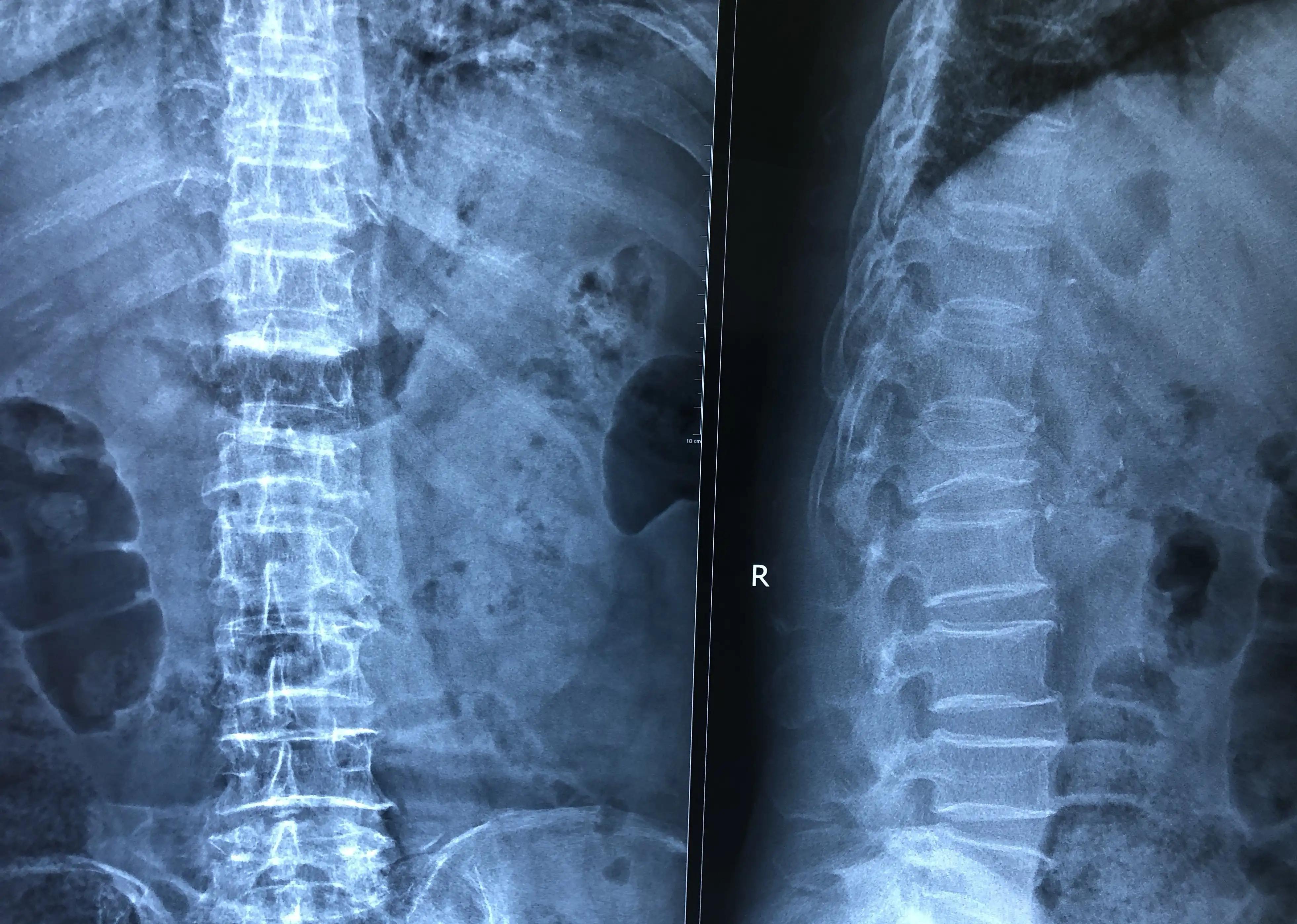 骨质疏松症的康复评定包括,骨质疏松症的康复治疗方法包括