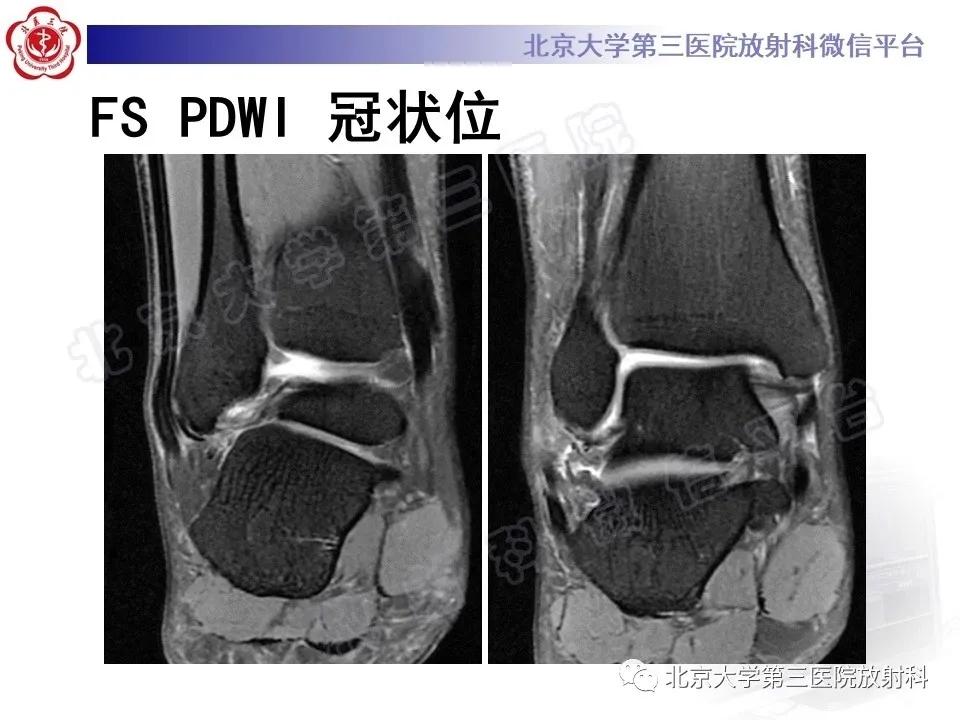 好文分享续集,腓骨肌腱脱位手术价格