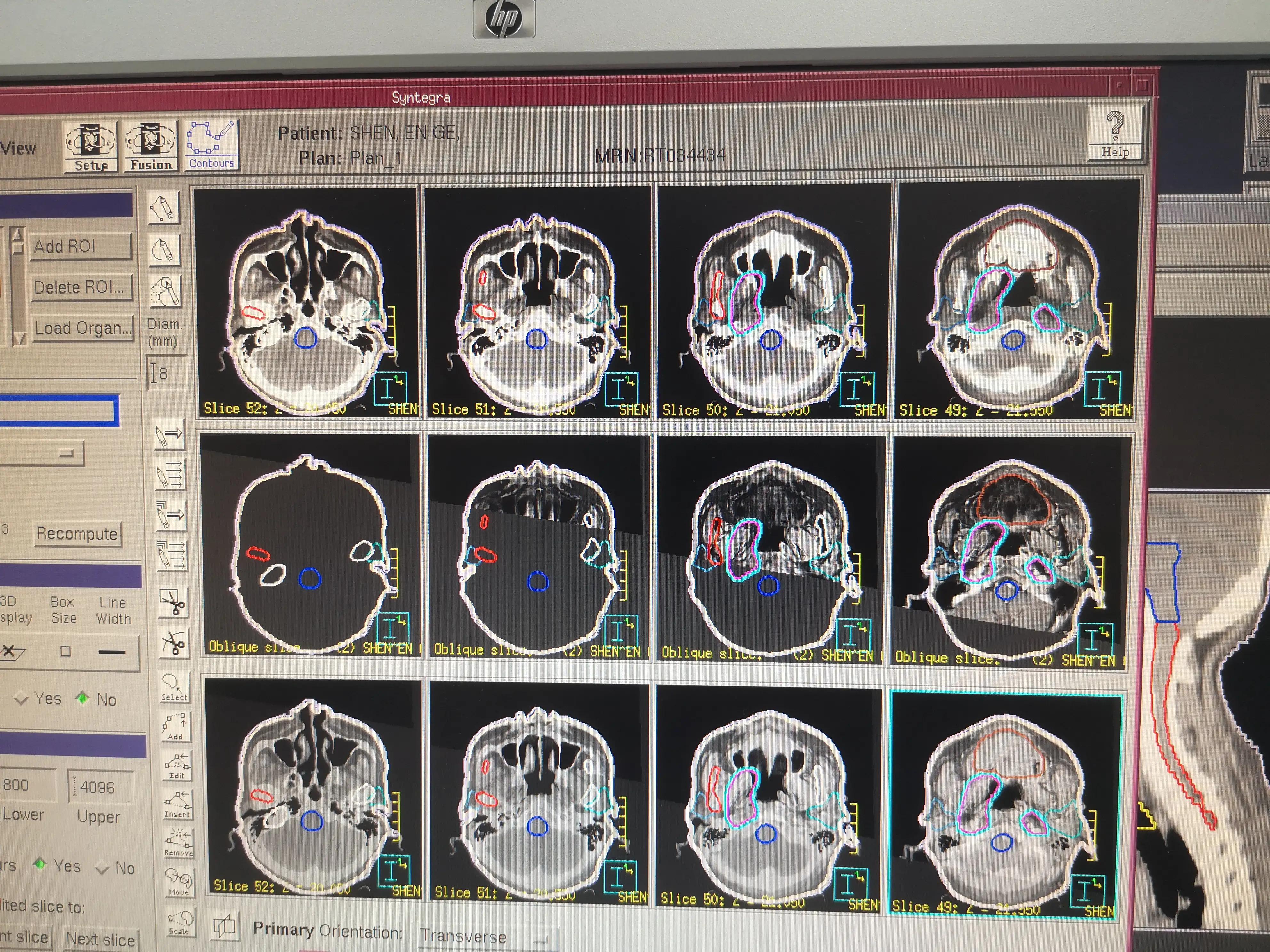 放射治疗流程课件,放射治疗的流程有哪些