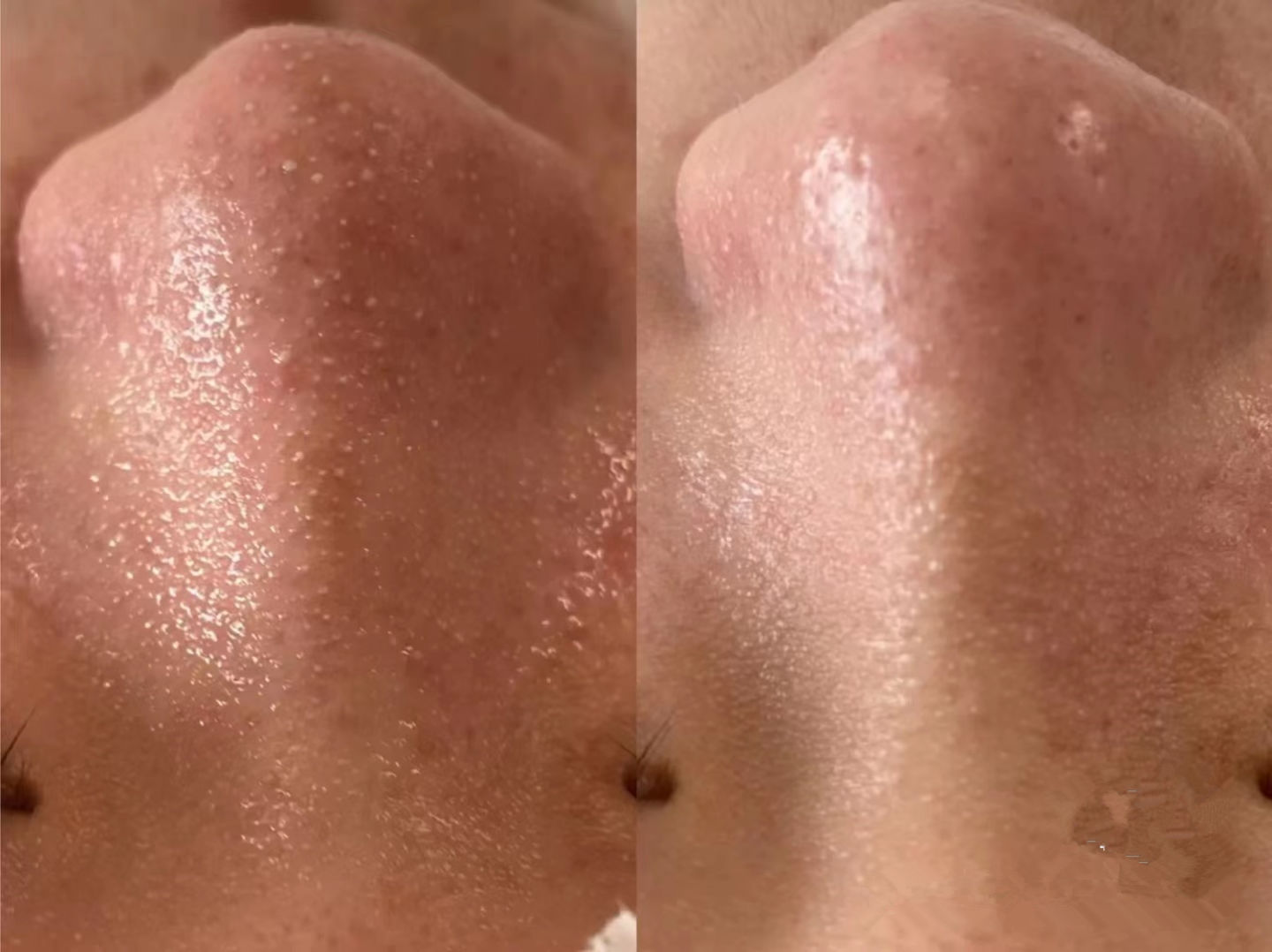 为什么鼻子可以挤出很大的黑头,用夹子挤出鼻子黑头