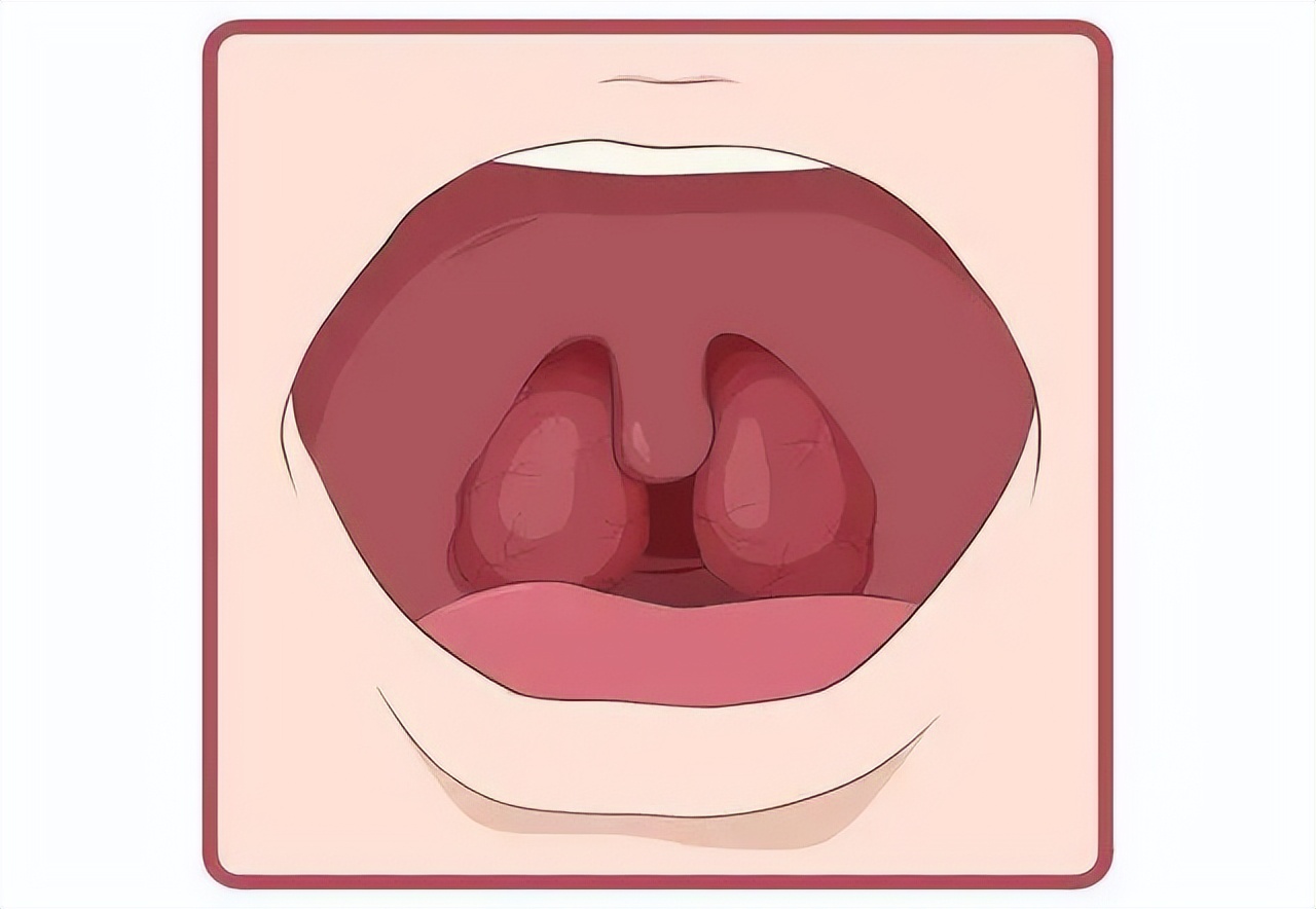 扁桃体肿大不切除有什么危害,扁桃体发炎对肾有危害