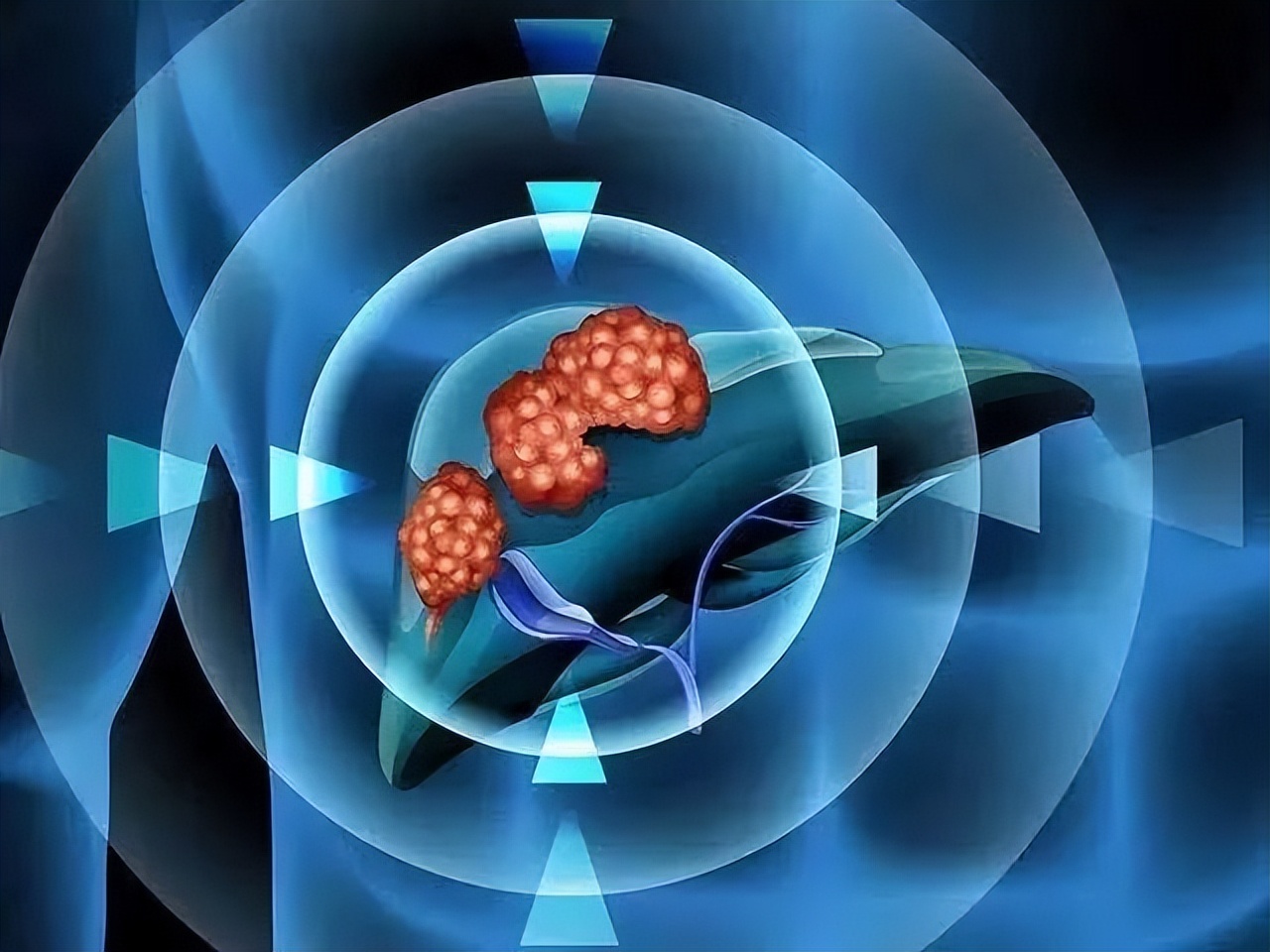 第7批国家集采药品平均降价,肝癌靶向药集采之后多少钱