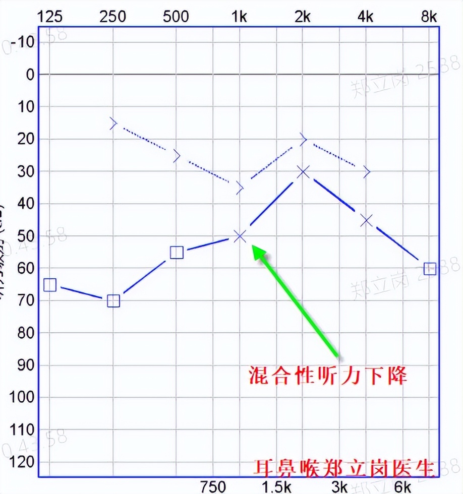 中耳炎手术后一直流脓怎么办,中耳炎术后复发吃什么药