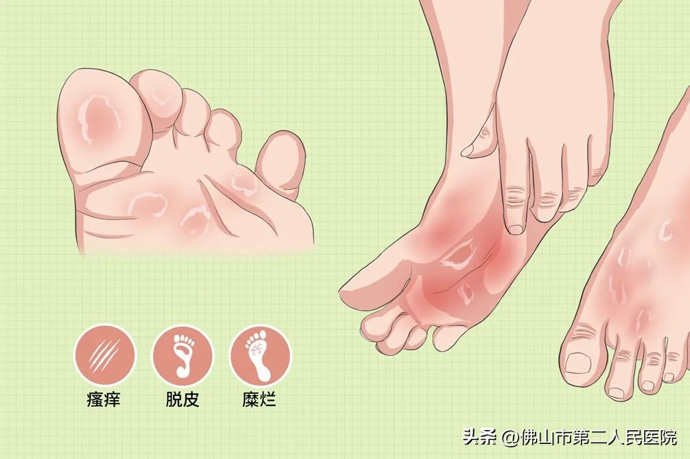 春季易发哪些皮肤病,秋冬常见皮肤病有哪些