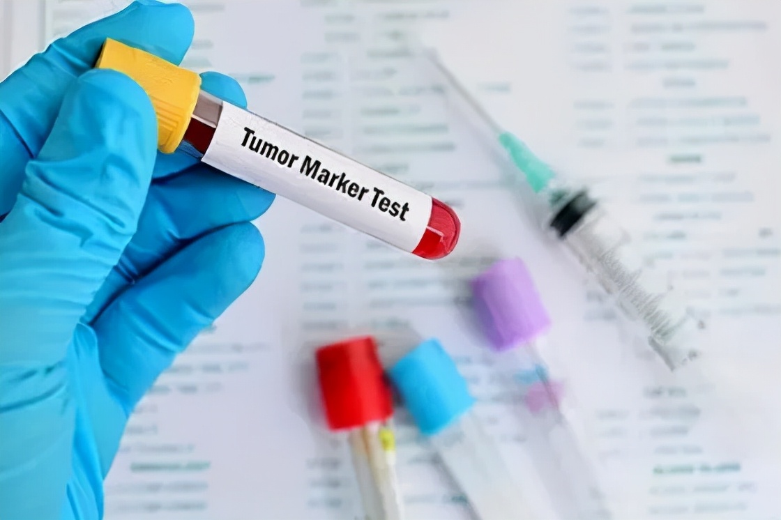 肿瘤标志物升高就是癌症晚期吗,肿瘤标志物升高是癌症的前兆吗
