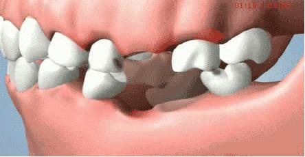 牙齿松动医生说周围没骨头怎么办,牙齿发黑断裂松动医生建议拔掉