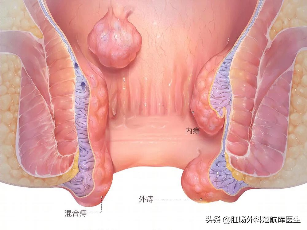 痔疮疼痛等级排名,痔疮术后疼痛难忍
