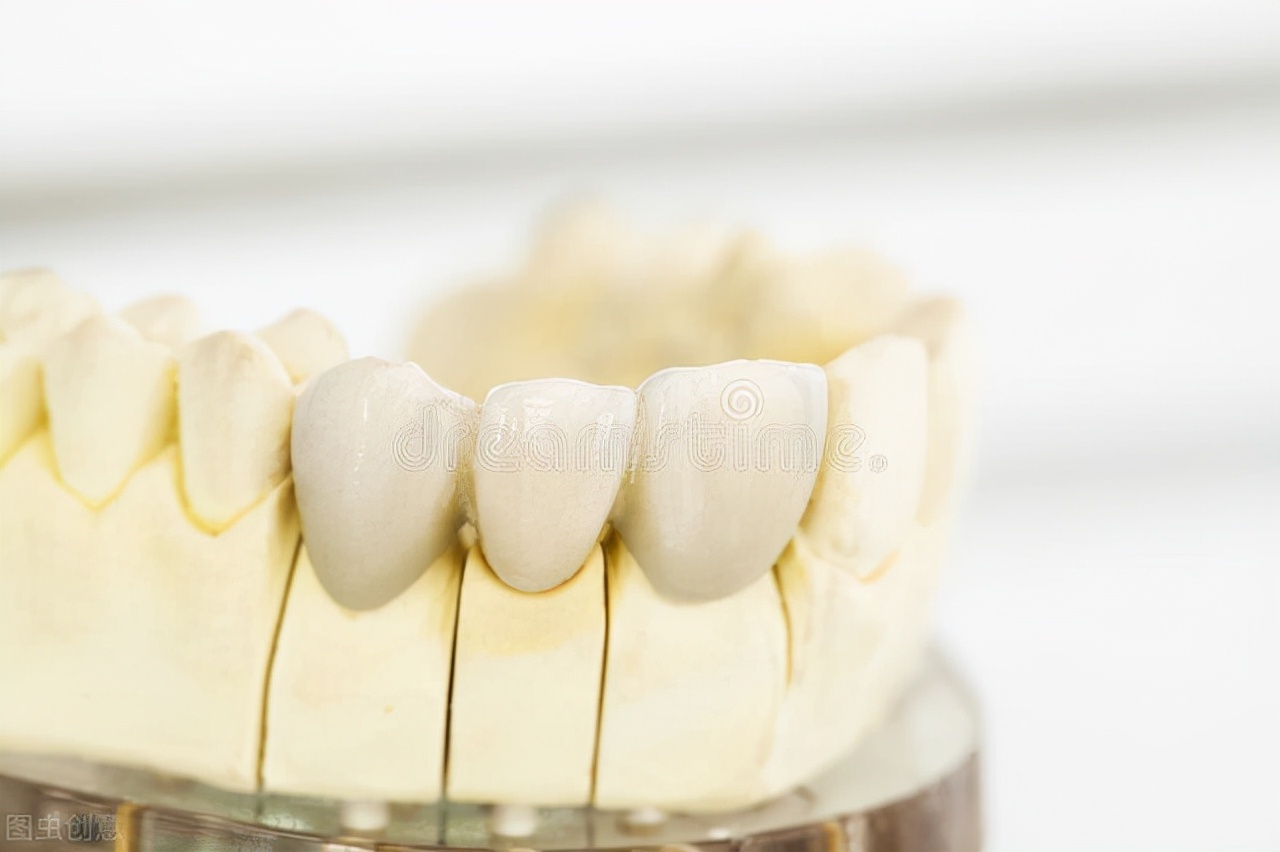 镶牙怎样评估,镶牙如何看起来美观