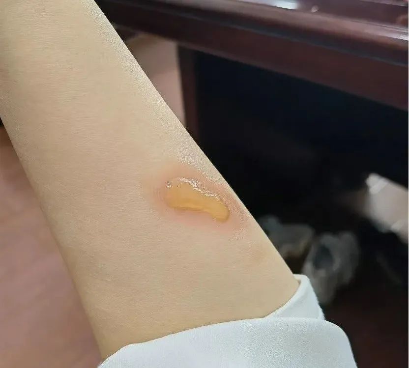 小孩在小餐桌烫伤怎么办,小朋友进厨房被烫伤了