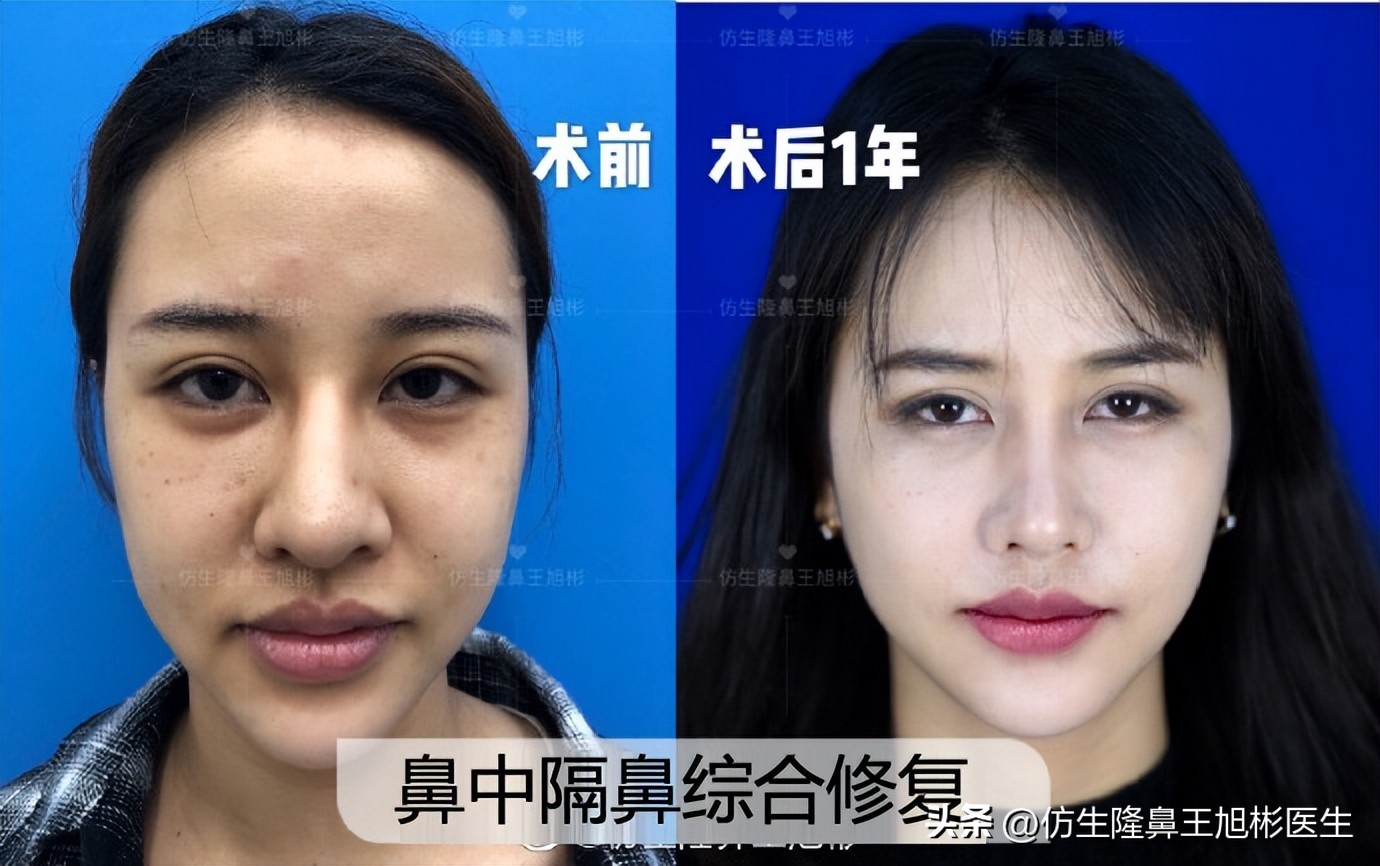 窄鼻子如何通过鼻整形来矫正,宽鼻子矫正方法