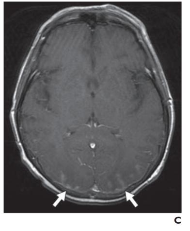 脑水肿的影像,脑水肿形成机制生理学