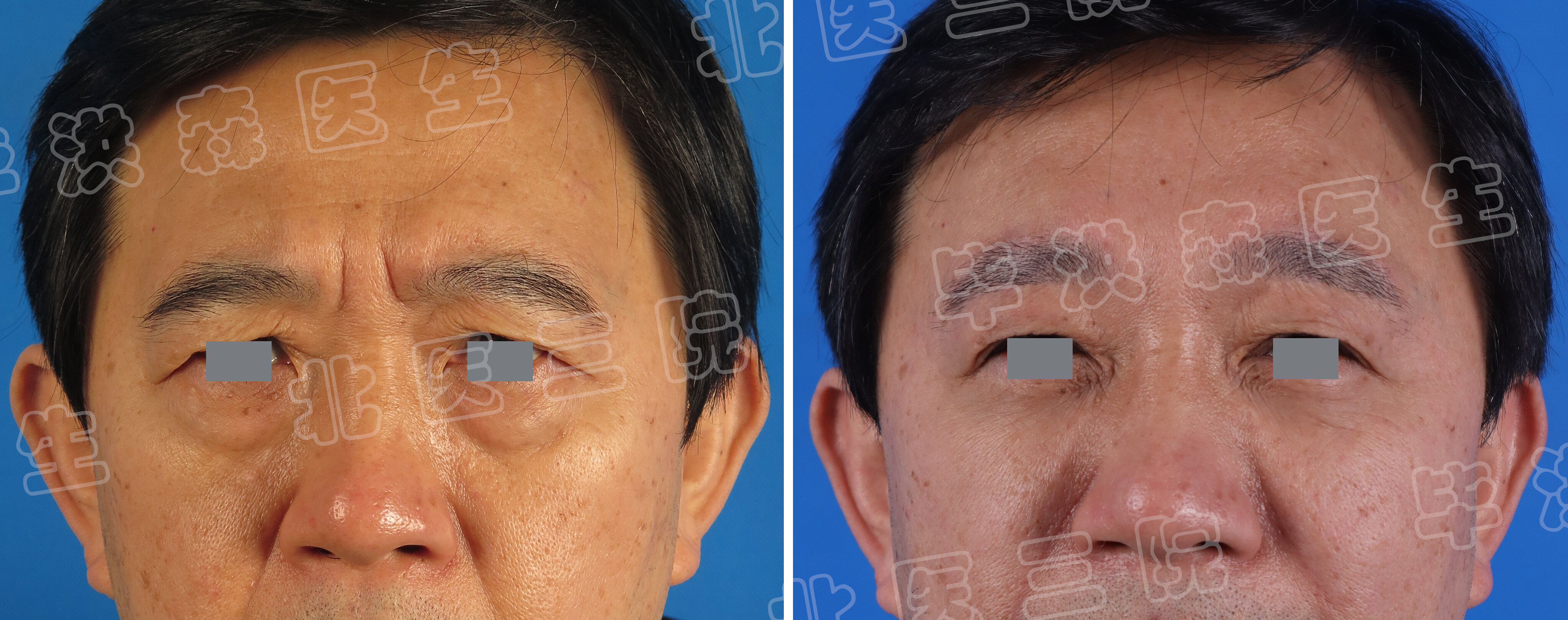 额颞部内窥镜除皱技术及应用,内窥镜额颞部除皱价格