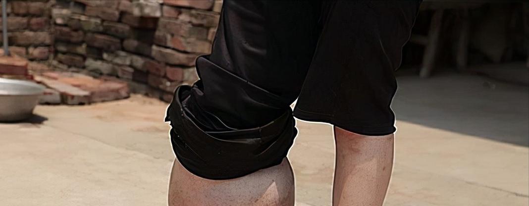 小腿巨粗的女孩,河南女子患病腿粗如大象