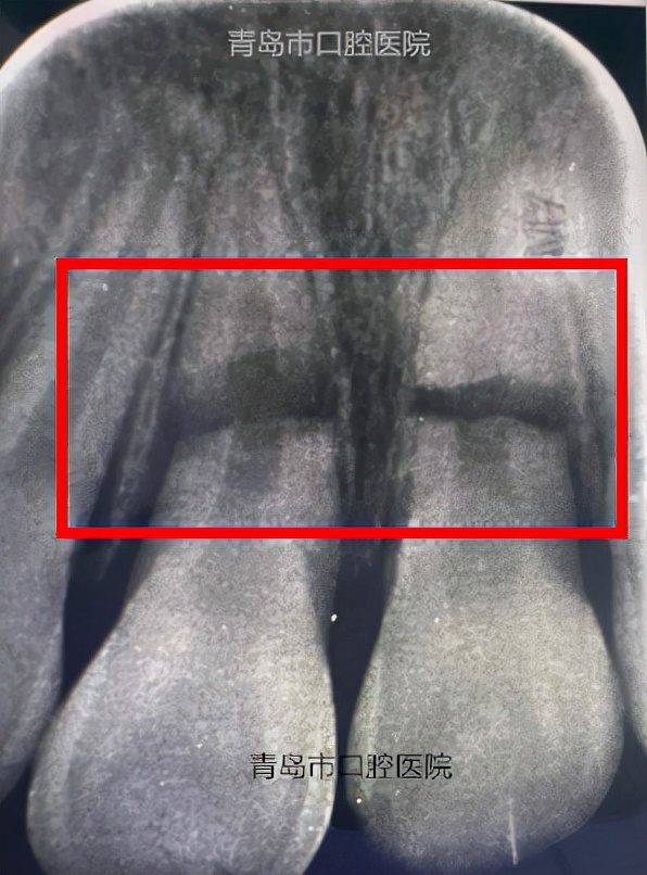 小孩门牙磕断了一个角,十岁孩子磕断门牙怎么办