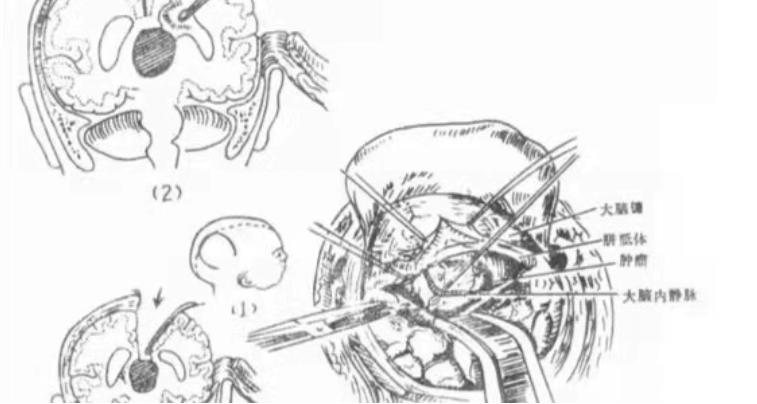儿童患上脑肿瘤怎么办？这3种常见的治疗方法，可供家长选择