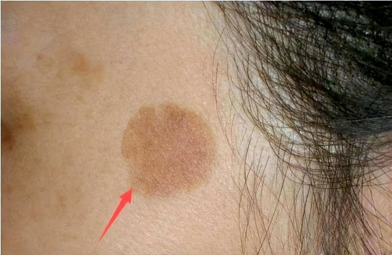 红霉素眼膏能治老年斑,红霉素软膏为什么不能消除老年斑