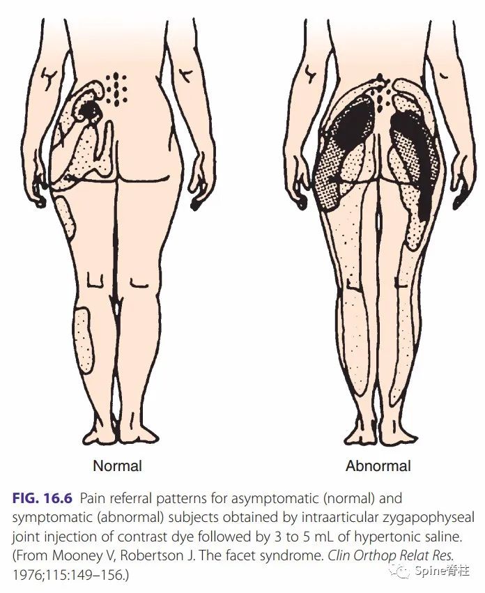 腰椎间盘突出症的治疗方法,腰椎间盘突出症状主要有哪些
