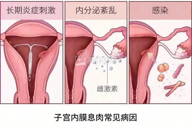 子宫内膜息肉中医,子宫内膜息肉手术需要住院吗