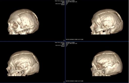 合肥华安脑科医院修复巨型颅骨缺损丨华安精湛医术，重塑颅骨