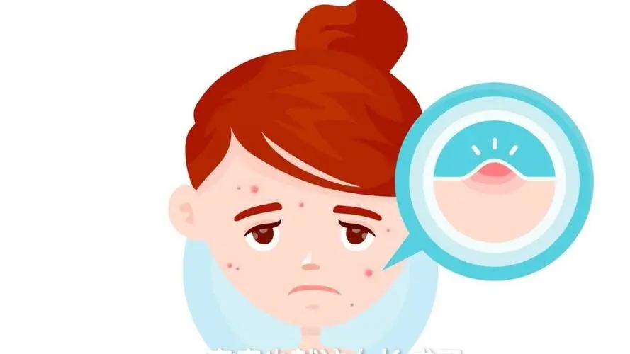 抗痘推荐22岁,青年人痘痘怎么治