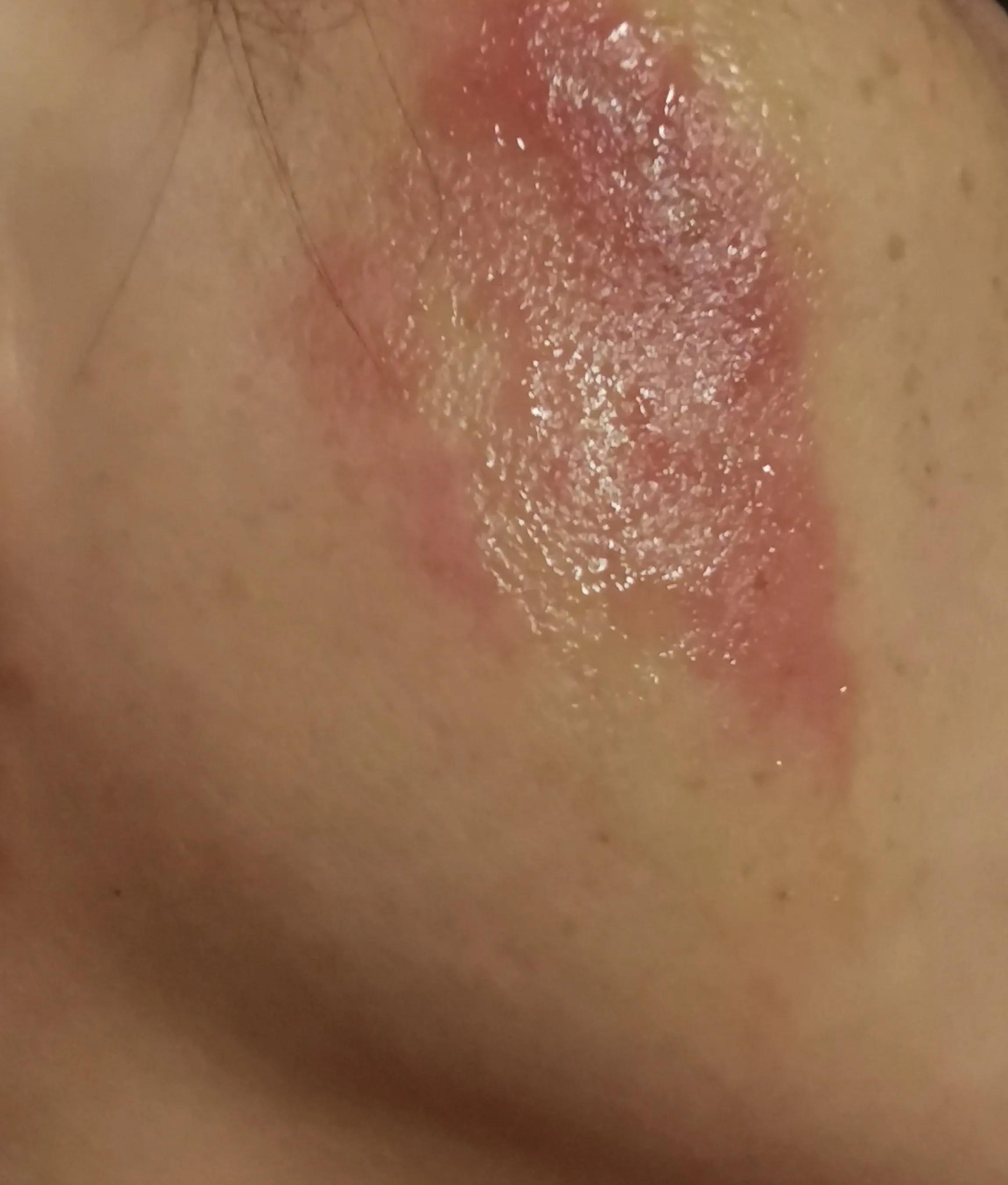 隐翅虫咬了后怎么处理,被隐翅虫咬了怎么办最快最有效