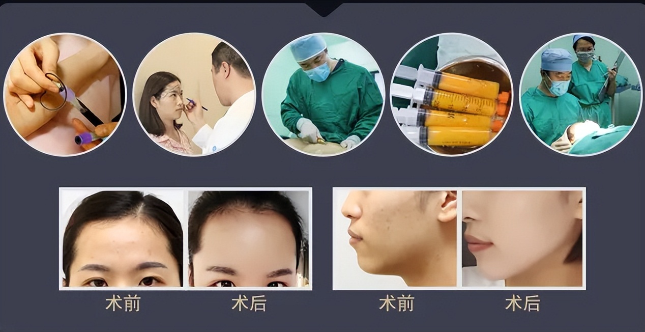 面部填充失败案例,脂肪填充面部失败案例