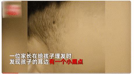 妈妈帮孩子理发发现蜱虫,小孩儿头上发现有蜱虫