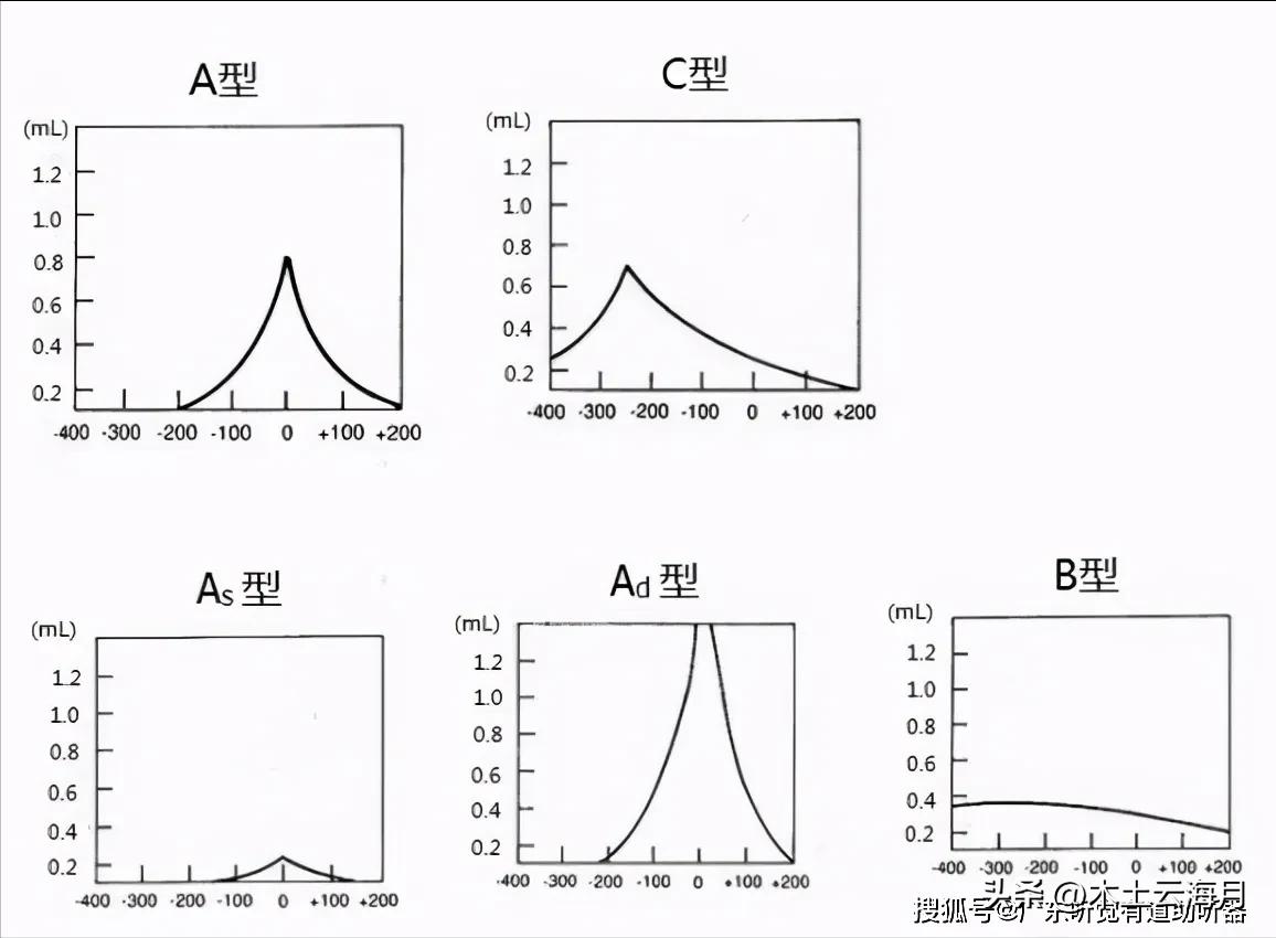 声导抗准确吗,声导抗峰值怎么看