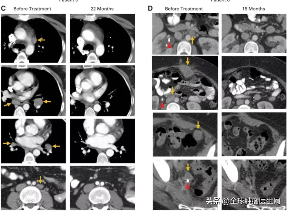 癌症免疫疗法取得重大突破,癌症患者战胜病魔的历程