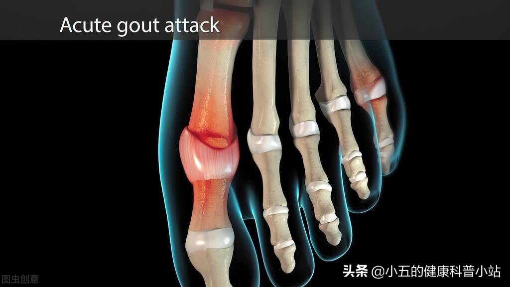 非布司他怎么吃可以根治痛风,吃非布司他痛风发作脚红肿怎么办