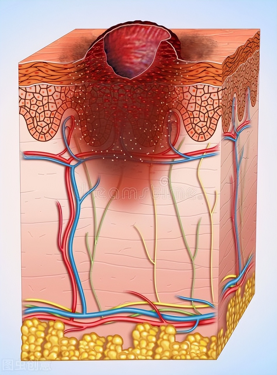 尿道口肿物，不容小觑，警惕隐私部位黑色素瘤