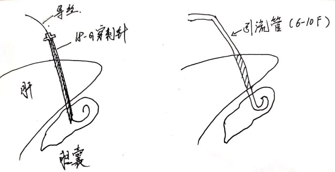 “一根细针”解除九旬病患的病痛！泗泾医院为高龄老人完成经皮经肝胆囊穿刺置管引流手术