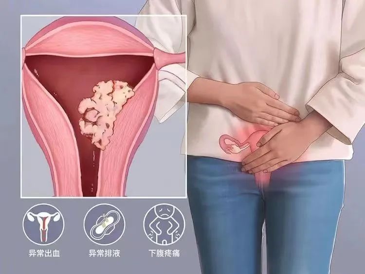 绝经后出血良性跟恶性的区别,绝经后异常出血