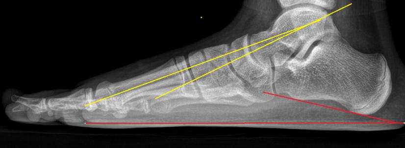 距下关节制动术成人效果如何,距下关节制动器作用