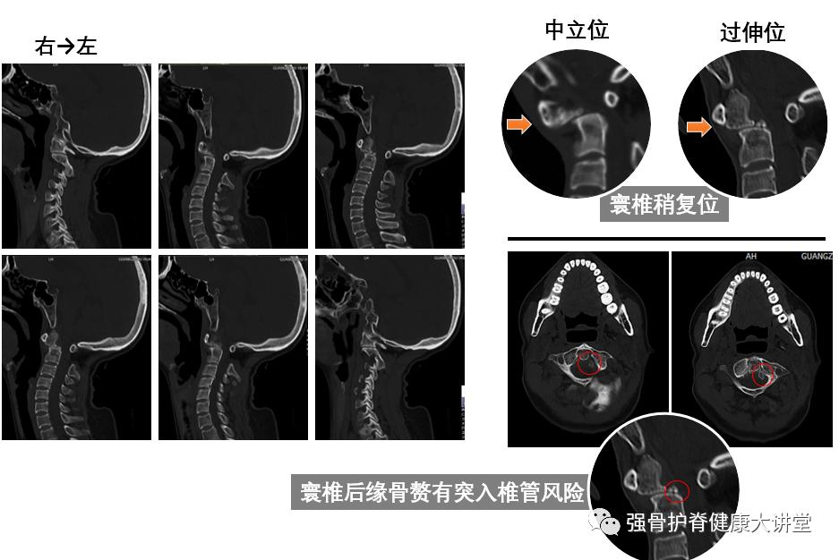 寰枢椎脱位能正骨复位吗,齿状突骨折伴寰枢关节脱位
