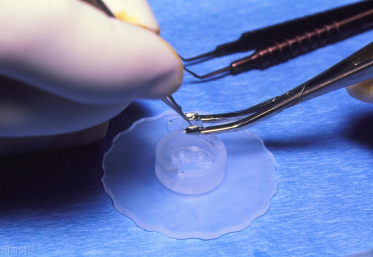 上海眼科院长:白内障手术有风险吗?如何选择适合自己的人工晶体