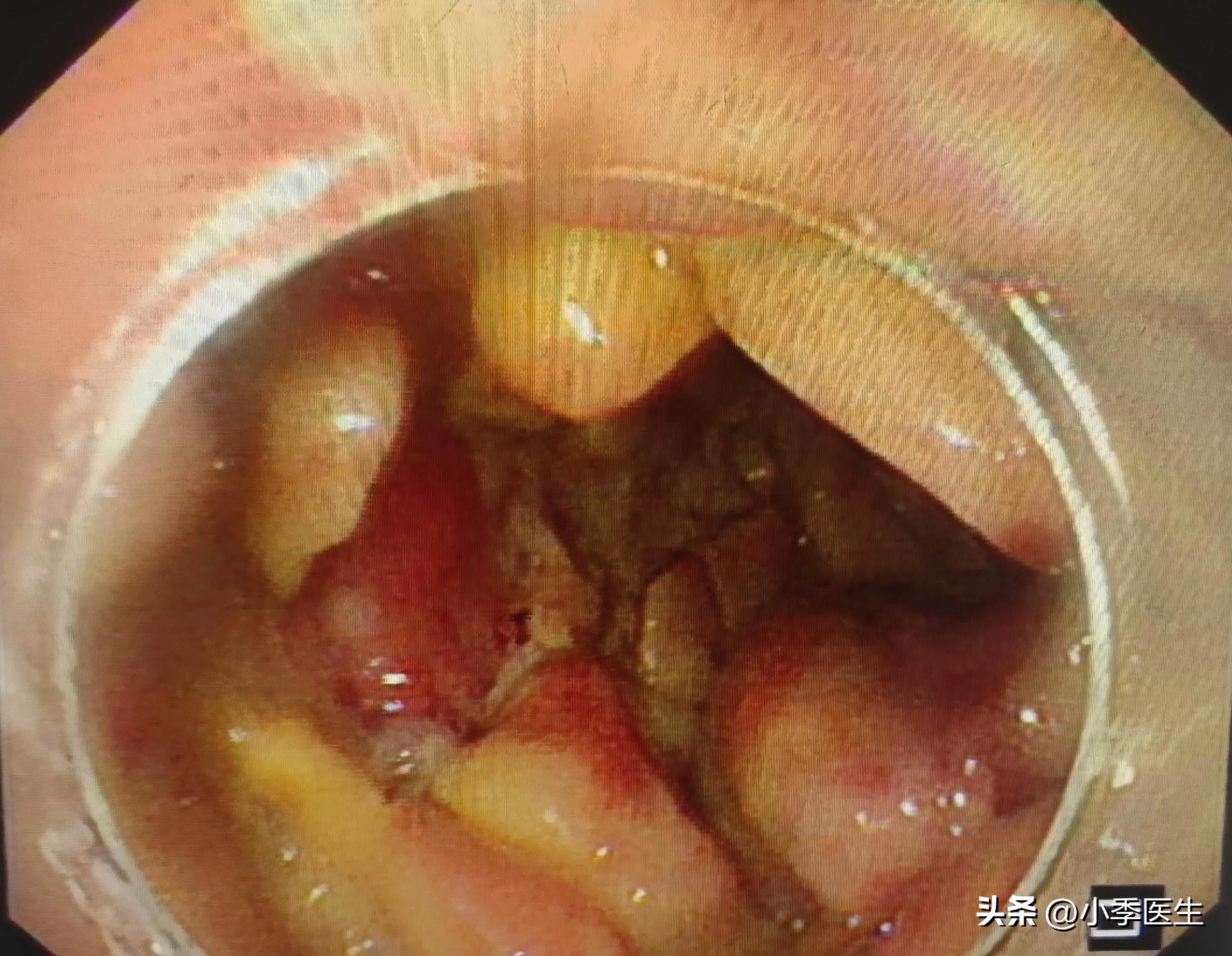 腹痛便血颜色是鲜红色,腹痛便血柏油便