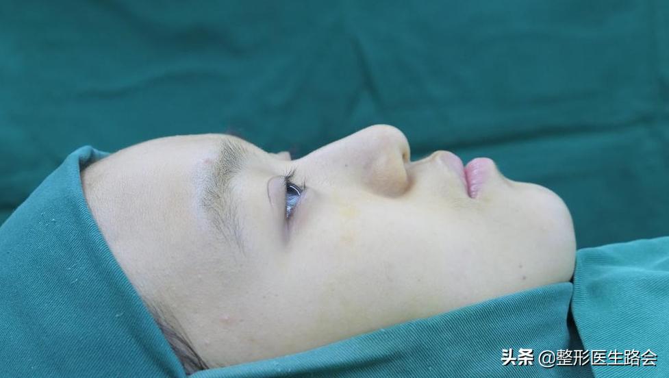 全脸整形记录恢复过程,女孩整形全过程