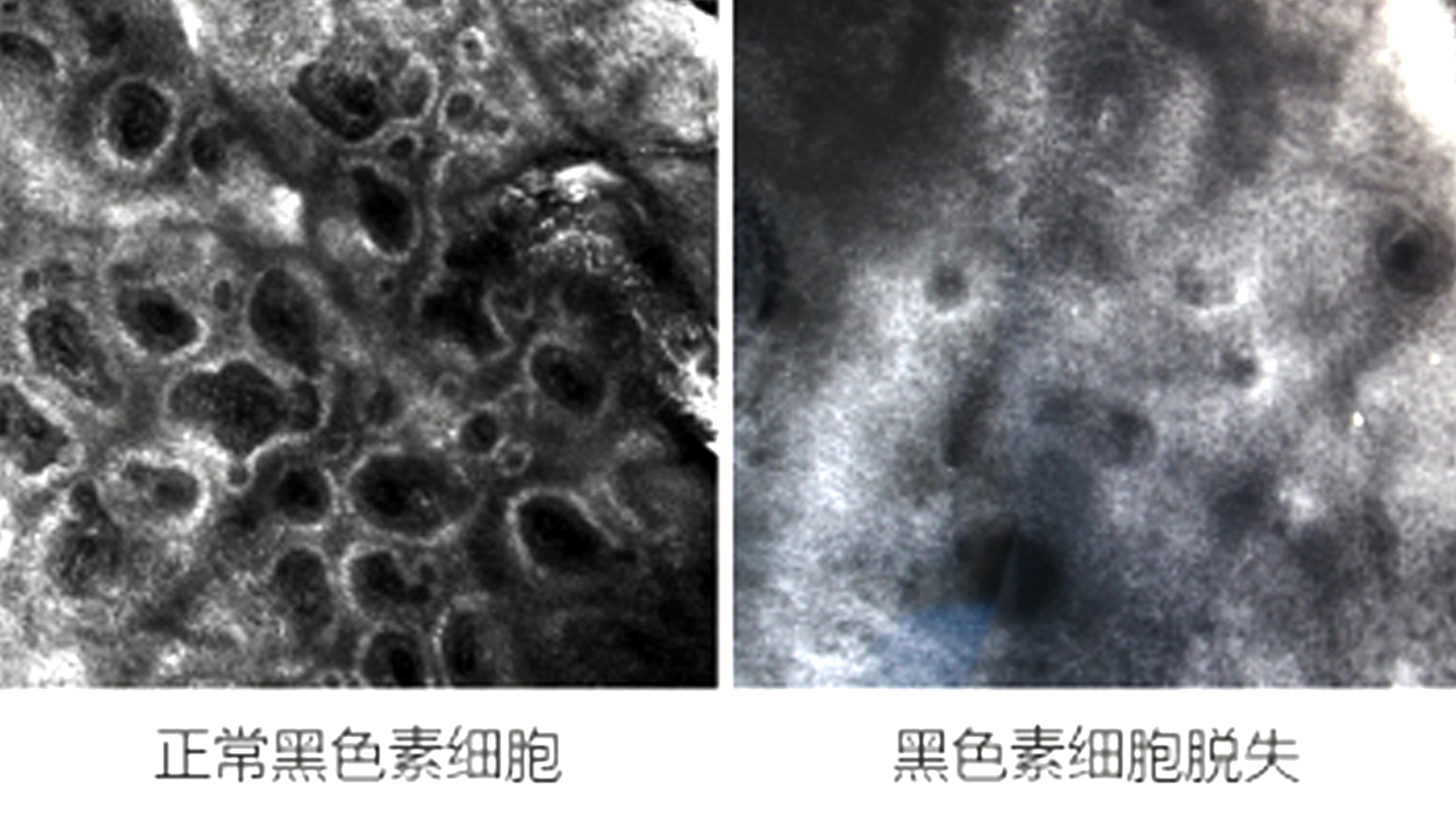 治疗白癜风近几年有何突破,白癜风11年