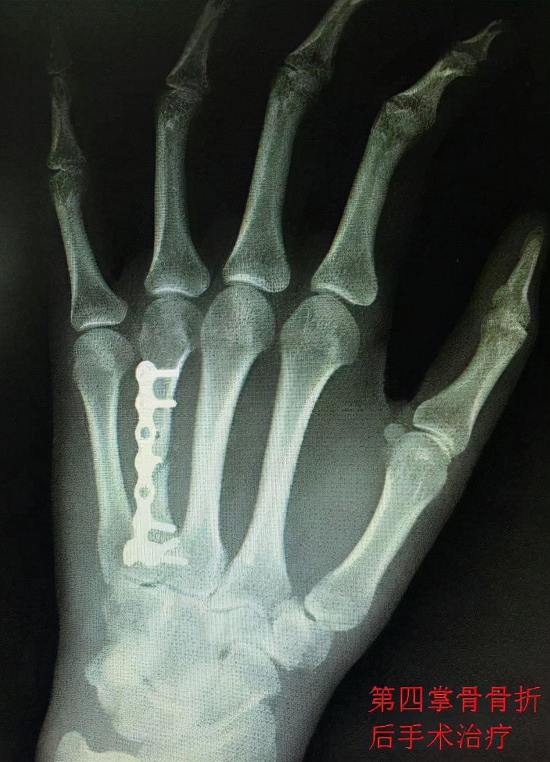 手掌骨折保守治疗和手术的优劣,手指骨折是手术还是保守治疗